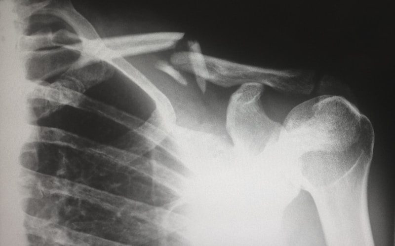 경추 목뼈 X-ray 이미지